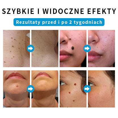 🏆JKSJKS® SpotlessDerm Kret i Brodawka Laserowy Pen